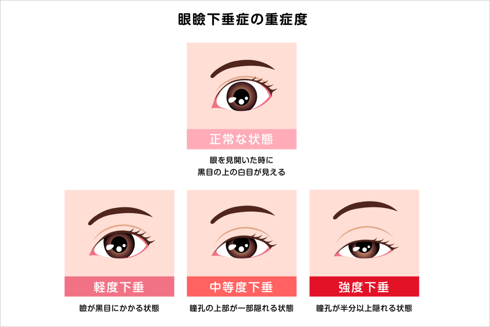 まぶたのたるみが気になる方へ